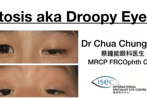Eyelid surgery by Prof Dr Chua Chung Nen