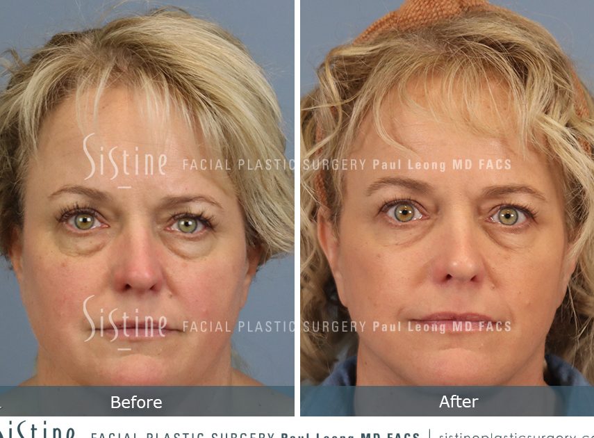 leong eye clinic surgery