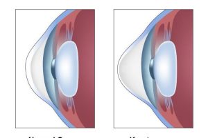 ODEX Optometrists | Vision Specialist | Keratoconus | Corneal Eye Disease | Vision Therapy | Children’s Vision Specialist Johor Bahru (JB), Malaysia