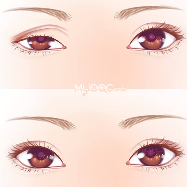 rawatan mata di puchong selangor